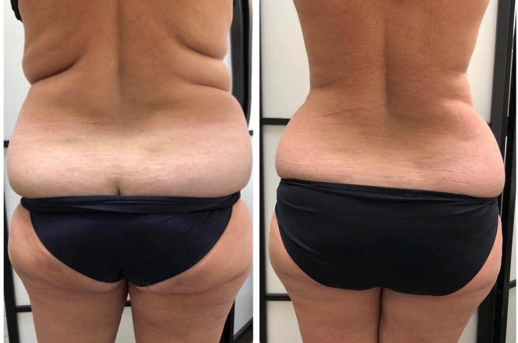 Real client lower-back and flank circumference before and after a CoolSculpting series