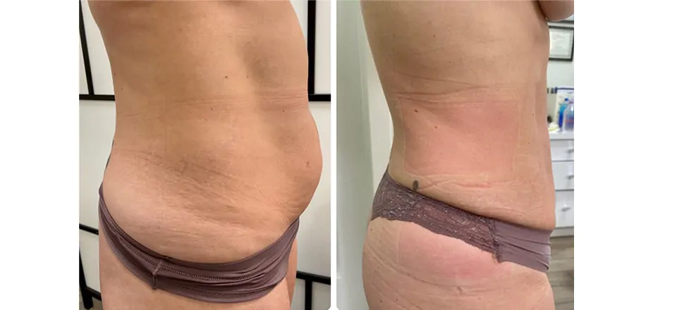 Real client side-profile abdomen before and after a non-invasive laser lipolysis series