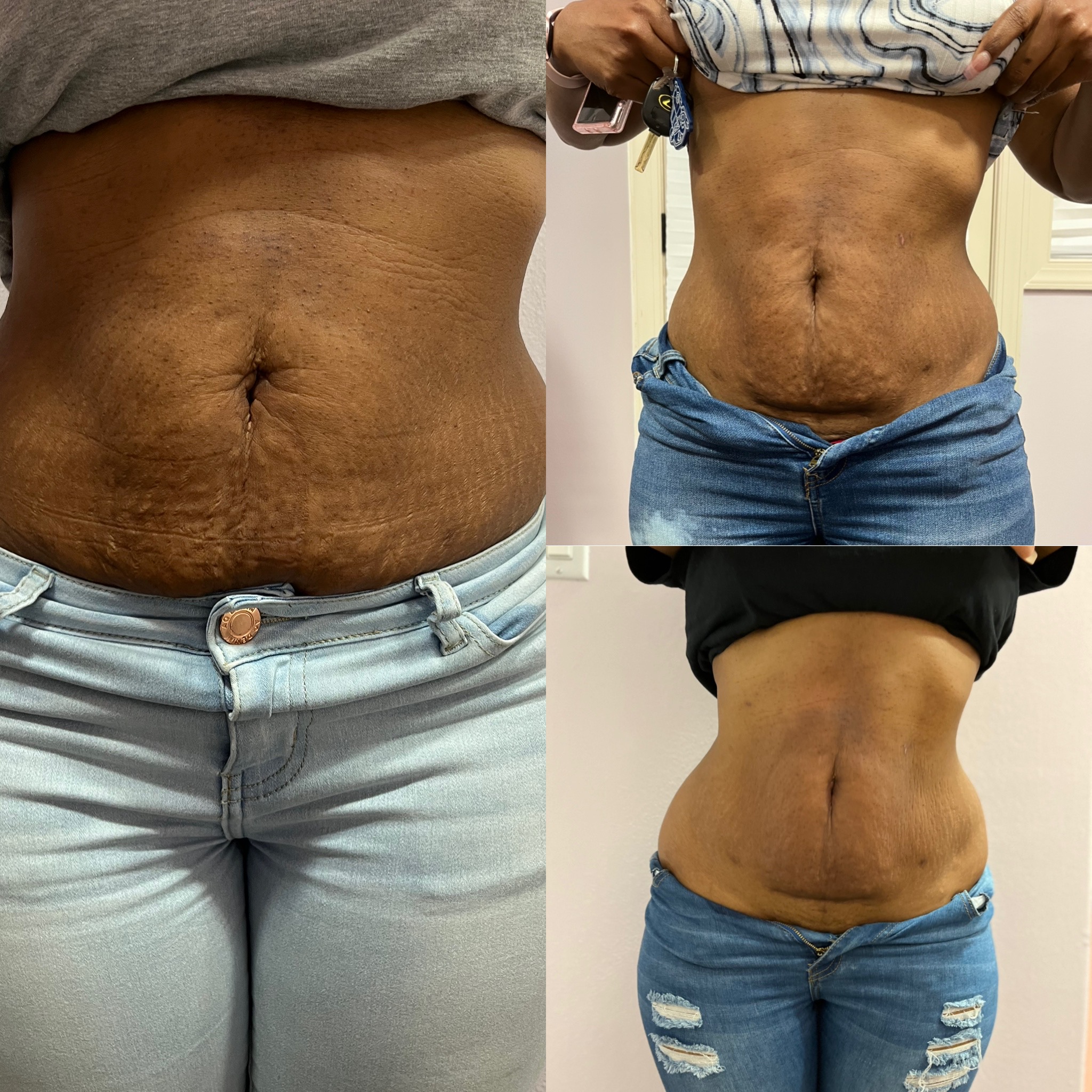 Real client abdomen progression across an ultrasonic cavitation series