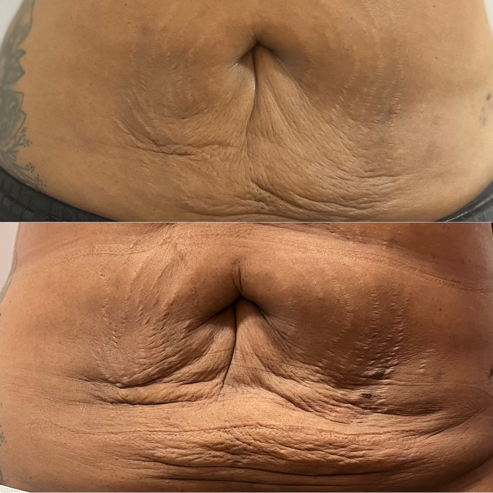 Real client abdomen before and after a radio frequency skin tightening series