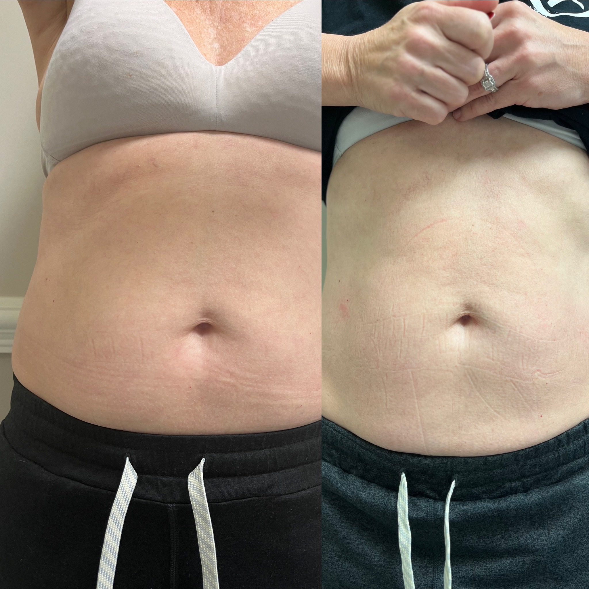 Real client front-abdomen before and after CoolSculpting treatment series