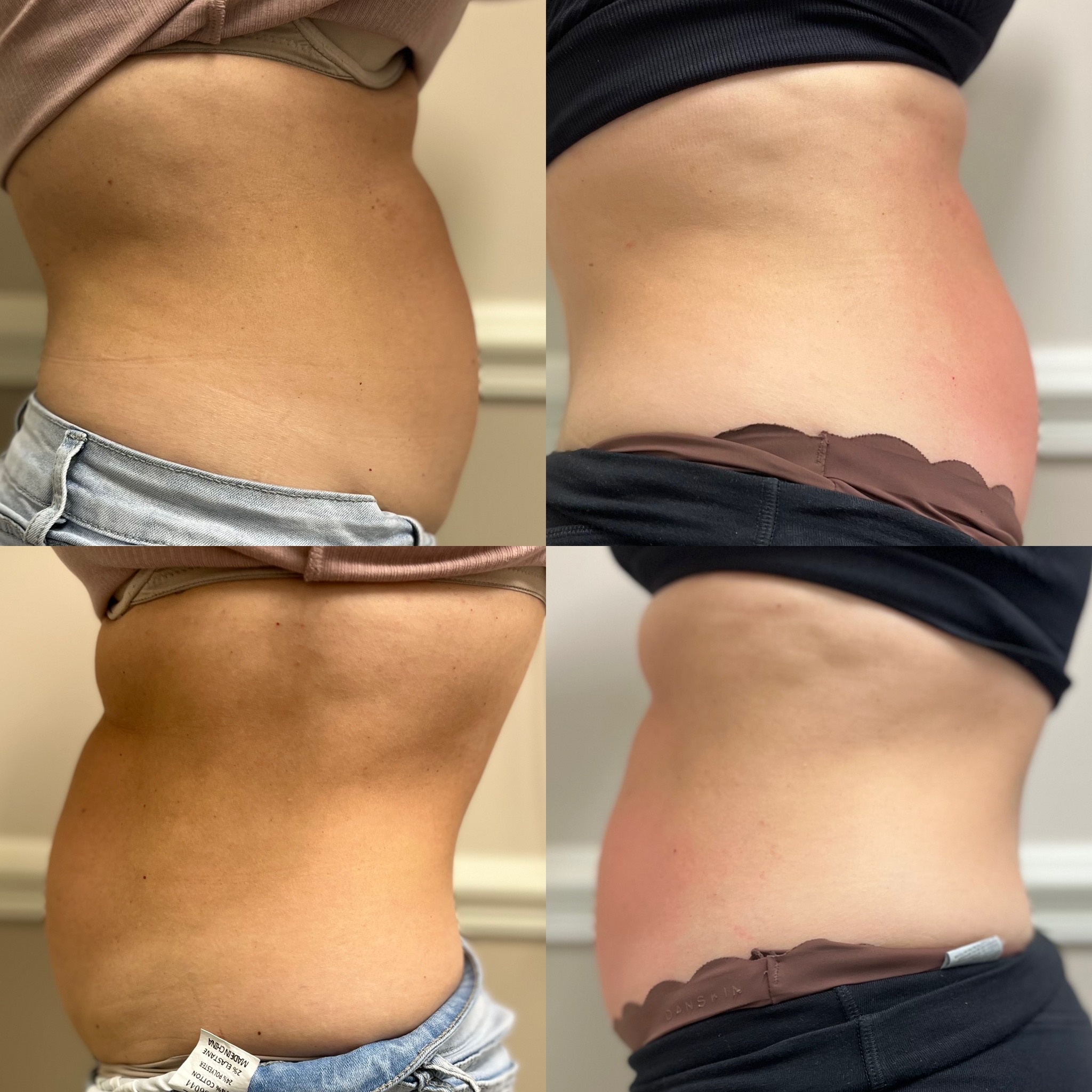 Real client side-profile abdomen before and after Emsculpt session series