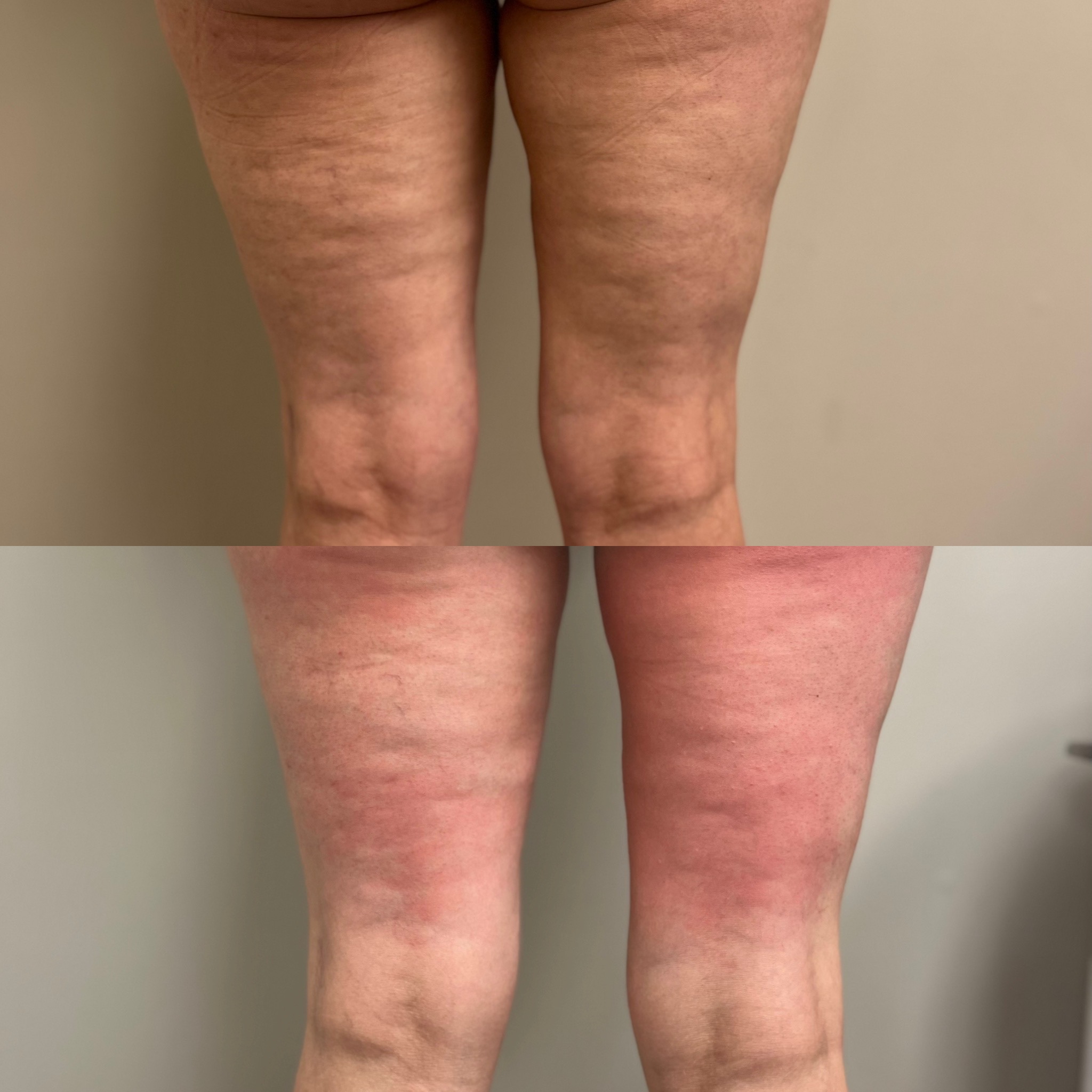 Real client thigh cellulite before and after a Velashape series